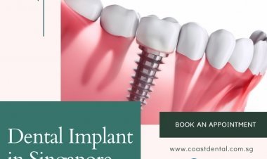 Dental Implants in Singapore | Coast Dental