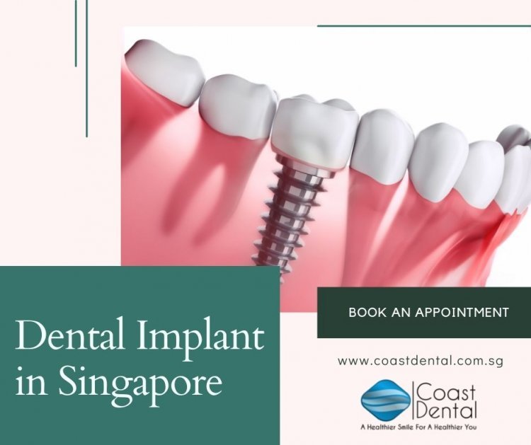 Dental Implants in Singapore | Coast Dental